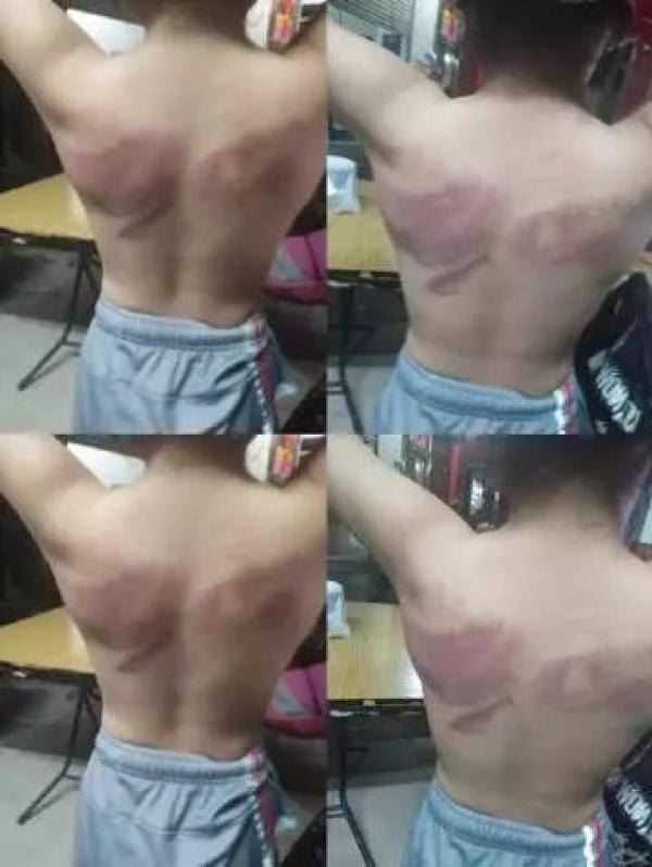 小学女教师戒尺体罚女生 学校:已和解 教师被辞退